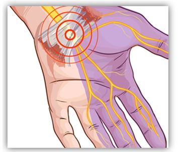 EBP8 - tunnel carpale